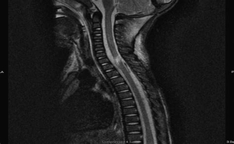 Spinal Cord Avulsion in the Pediatric Population: Case Study... : Pediatric Emergency Care