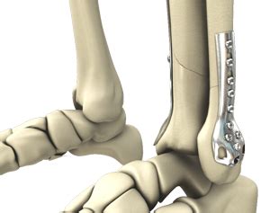 Open Reduction and Internal Fixation of the Ankle Kentucky | Ankle ...