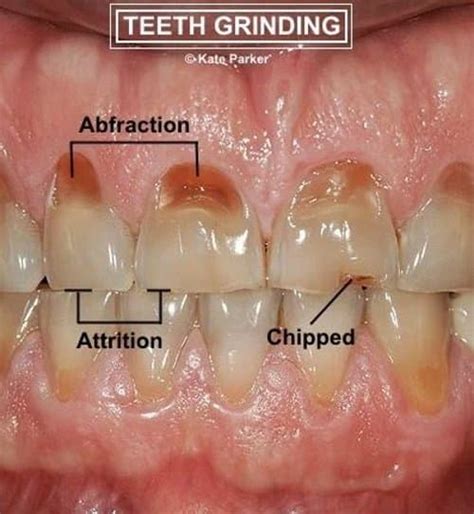 How to Stop Grinding Your Teeth - HealthProAdvice