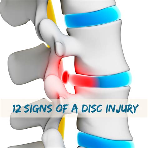 12 Signs of a Disc Injury - Proback Clinics