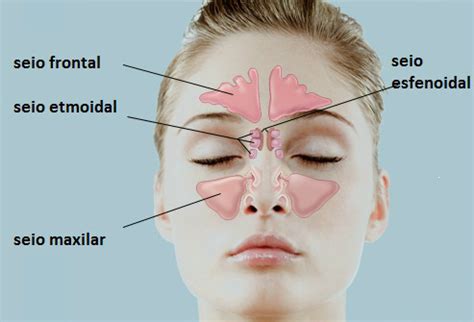 RINITE e SINUSITE é a mesma coisa? - Vitae - Centro Clínico Integrado