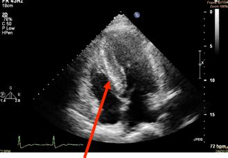 2D Echo/Doppler Study (2-Dimenstional Echocardiography/Doppler study) - Peter Yan Cardiology Clinic