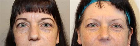 Eyelid Surgery (Blepharoplasty) Before and After Photos - Dr Anzarut ...