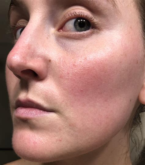 Day 1 on Triple Rosacea Cream : r/Rosacea