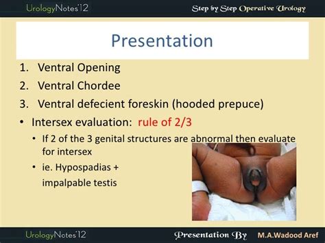 Hypospadias part 1 introd (step by step oper series)