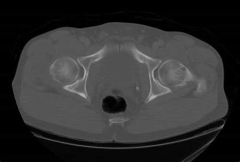 Herniation pit of the femoral neck - wikidoc