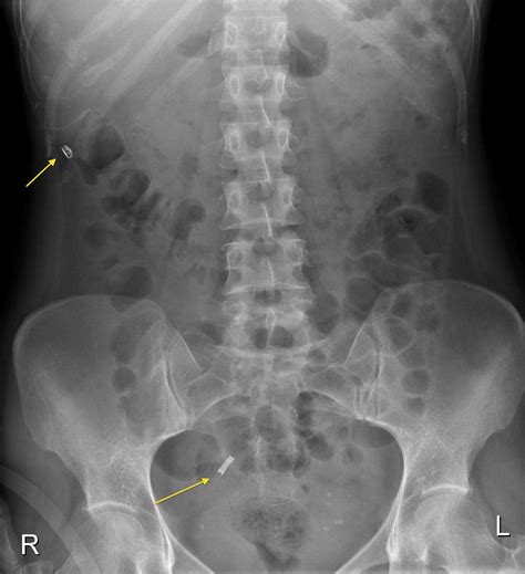 Tubal ligation clips - Radiology at St. Vincent's University Hospital