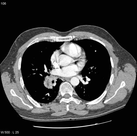 Bronchial arterial aneurysm | Radiology Reference Article | Radiopaedia.org