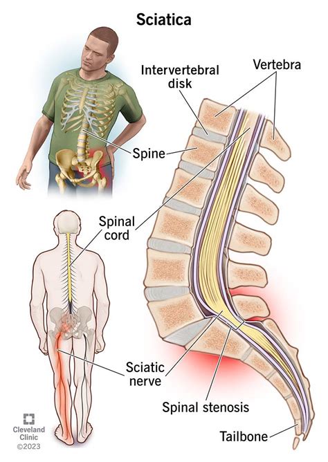 Sciatica: What It Is, Causes, Symptoms, Treatment & Pain Relief