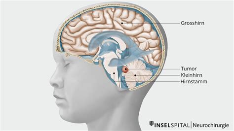 Medulloblastom | Neurochirurgie Inselspital Bern