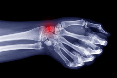 Broken Wrist Treatment at Orthotics Plus - Melbourne