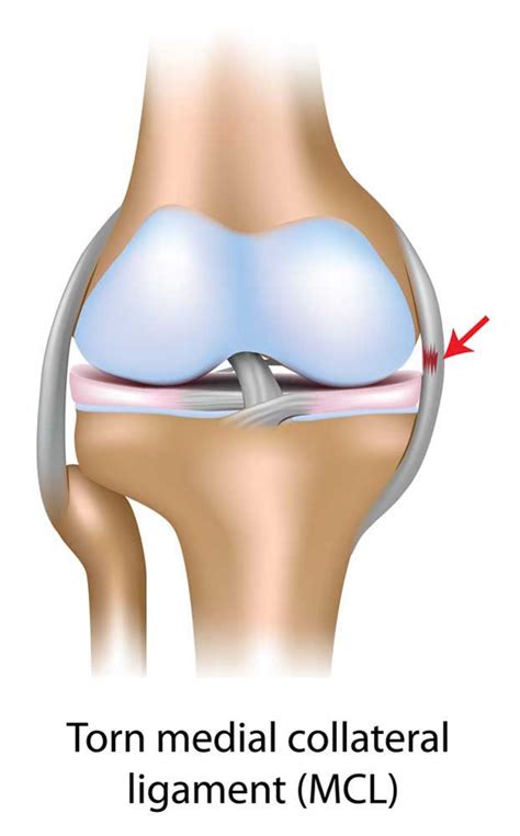 MCL Injury |Medial Collateral Ligament | Orthopedic Knee Specialist | Manhattan, New York City, NY