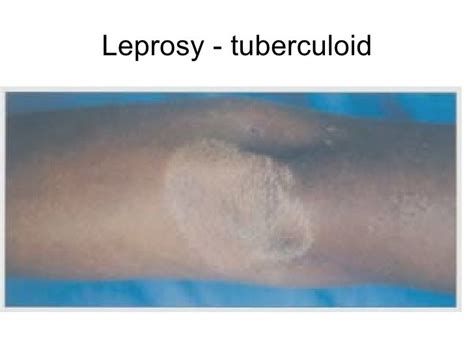 Tuberculosis and Leprosy