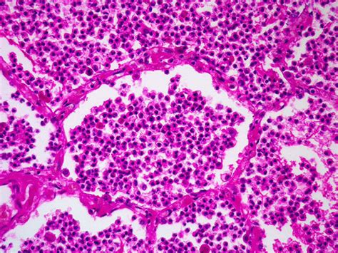 Lobar Pneumonia Histology