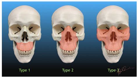 Maxillary Fracture