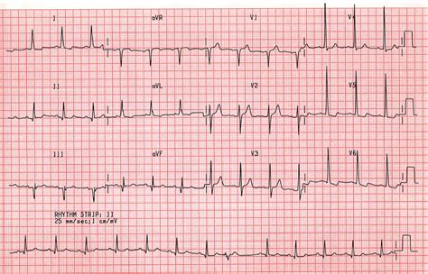 Case A4. Old Inferior Infarction; Left Ventricular Hypertrophy. St ...