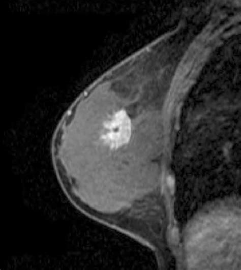 MRI finding for non-triple negative breast cancer in 46 year-old woman.... | Download Scientific ...