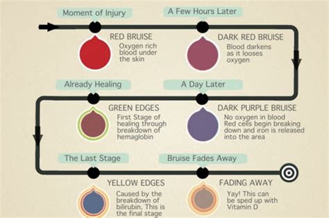 stages of a bruise : r/coolguides