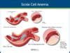 Sickle Cell Anemia Nursing Care and Management: Study Guide
