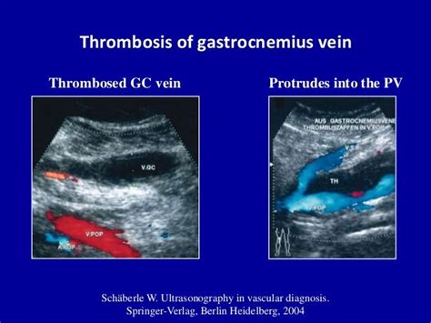 gastrocnemius vein dvt - | Vascular ultrasound, Deep vein thrombosis ...