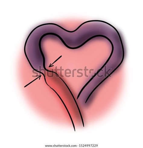 Heart Coronary Artery Spasm Stock Illustration 1524997229 | Shutterstock