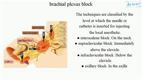 brachial plexus block (English) - Medical terminology for medical students - - YouTube