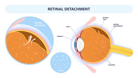 Retinal Detachment Vision