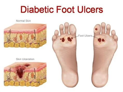 Diabetic Foot Surgery In Bhopal at best price in Bhopal | ID: 23033227312