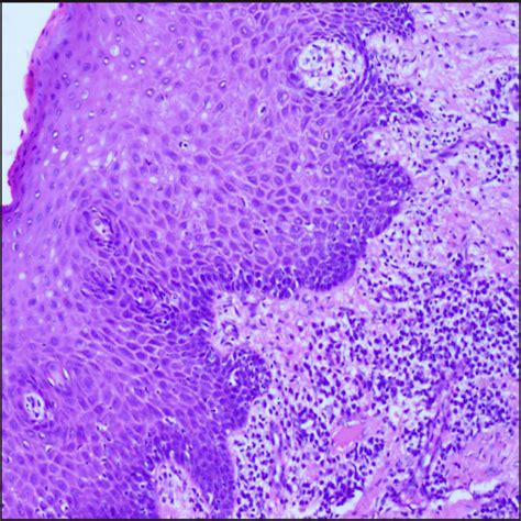 Gingival Hyperplasia Histology