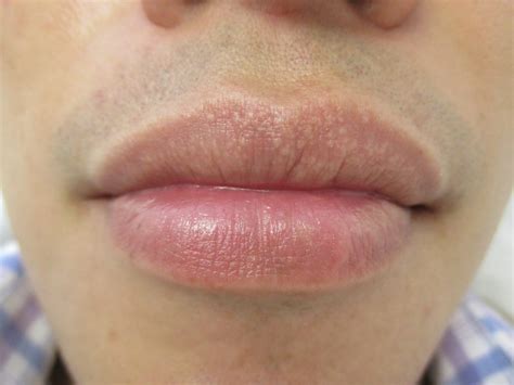 11 Tips to Prevent and Treat Fordyce Spots on Lips