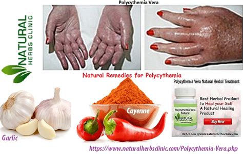 Natural Remedies for Polycythemia Vera to Get Rid of It