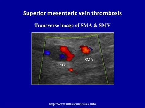 Doppler ultrasound of portal vein thrombosis