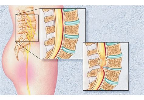 Nonsurgical treatment options for lumbar spinal stenosis - Mayo Clinic