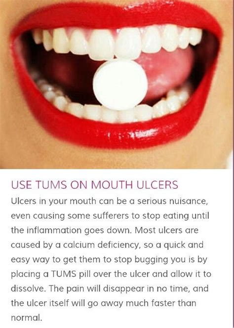 Tums for mouth ulcers | Mouth ulcer home remedy, Sore in mouth remedies, Mouth ulcers