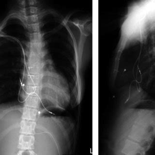 Chest X-ray just before transvenous pacemaker implantation at the age ...