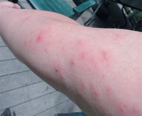 Poison Ivy Rash - Pictures, Treatment, Symptoms, Contagious, Duration