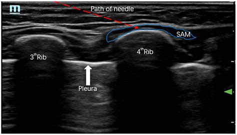 Frontiers | Case report: Ultrasound-guided bilateral serratus anterior plane block in intensive ...