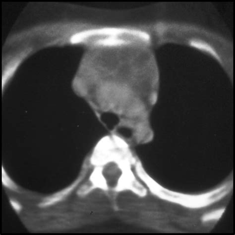 Thymic Cyst | Pediatric Radiology Reference Article | Pediatric Imaging ...