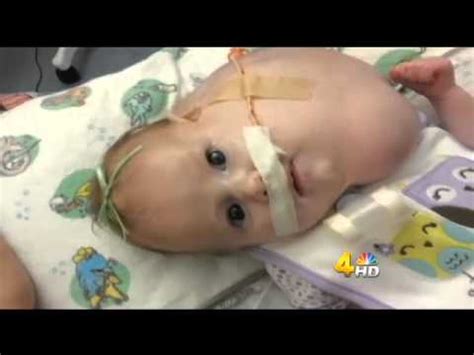 Baby battles rare tumor growing inside mouth WSMV Channel 4 2) - YouTube