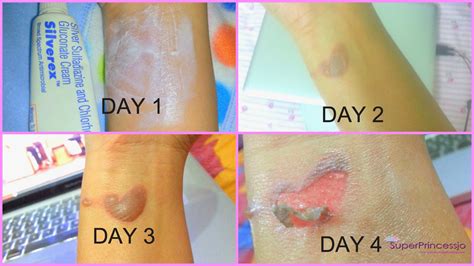 How To Cover A Burn Blister With Makeup - Mugeek Vidalondon