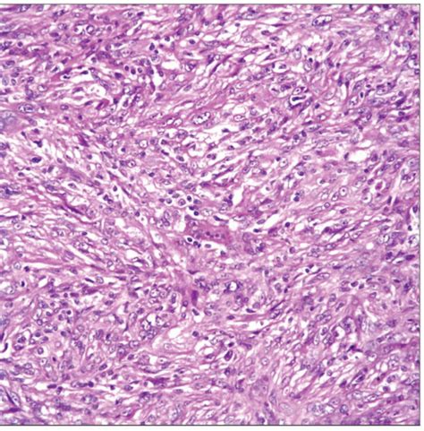 Malignant Mesothelioma | Basicmedical Key