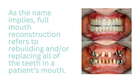 Full Mouth Reconstruction - The Wisdom Teeth Guru | Dr. Kiet Tran