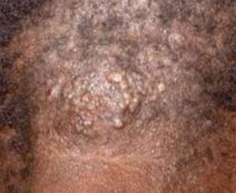 Itchy Bumps on Scalp, Neck, Causes, Red, Hurts, Pictures, Raised, Small, How to Get Rid