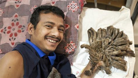 Surgeon removes man's 'tree growths' | Newshub