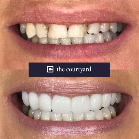 Porcelain Veneers | Courtyard Dental | Huddersfield