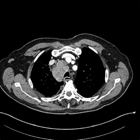 CT image of chest showing right hilar mass and enlarged | Open-i