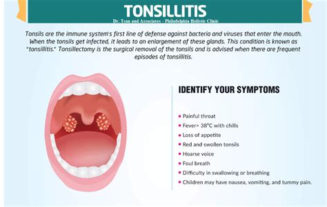 Tonsillitis Causes Symptoms And Diagnosis | My XXX Hot Girl