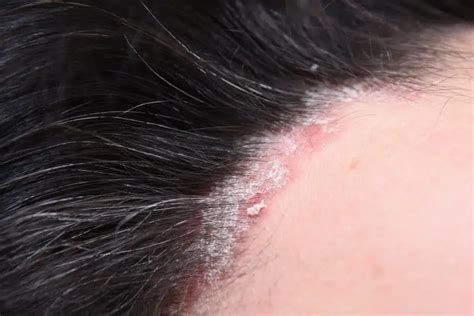 Scalp Psoriasis Treatment: What Works? - Riverchase Dermatology