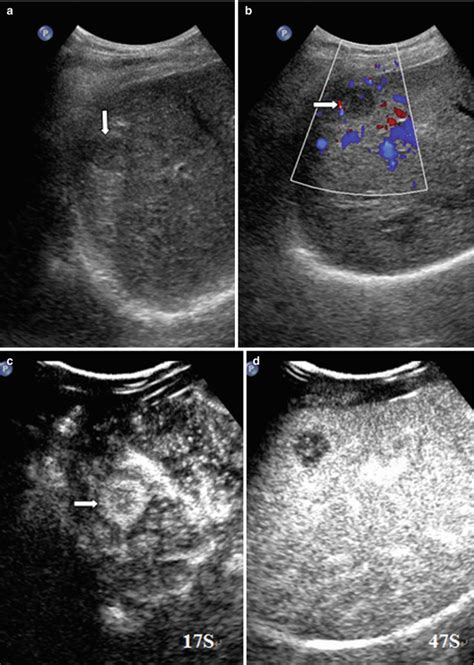 Liver Lesions Ultrasound