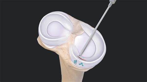 Arthrex - FiberStitch™ All-Inside Meniscal Repair Technique